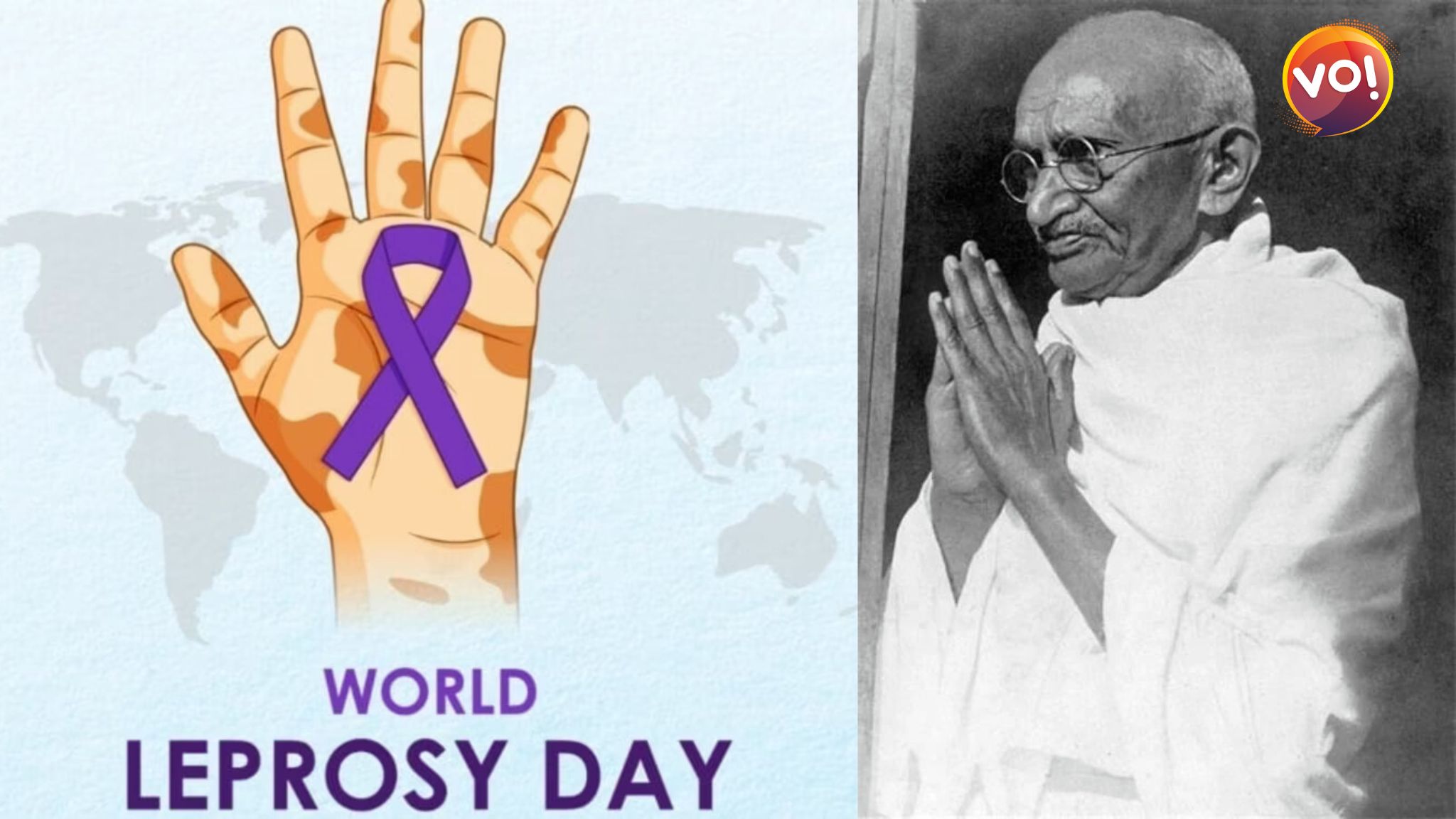 World Leprosy Day is observed on January 30 every year, coinciding with the death anniversary of Mahatma Gandhi.